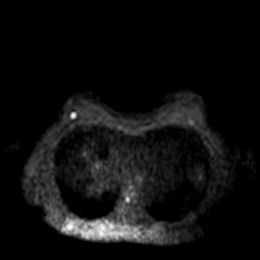 乳腺腫瘍の画像診断
