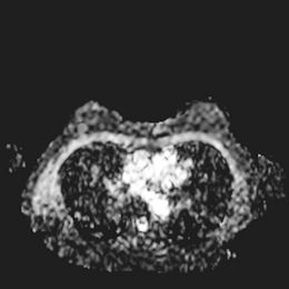 乳腺腫瘍の画像診断