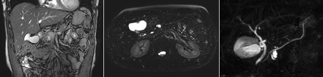 MR cholangiopancreatography (MRCP)