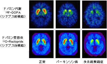 転移リンパ節のヨードとFDG集積との関連