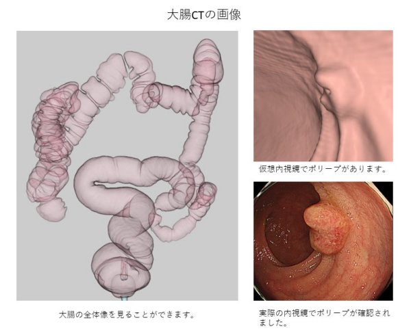 大腸CT