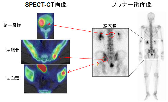 骨シンチでのSPECT-CTの有用性
