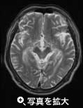 MRI