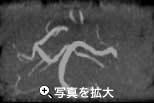 MRアンギオグラフィ
