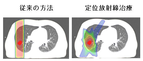 体幹部定位放射線治療
