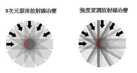 強度変調放射線治療