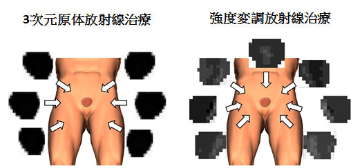 強度変調放射線治療