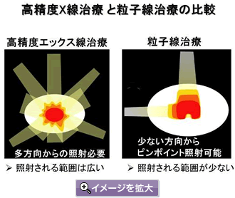 高精度X線治療と粒子線治療の比較