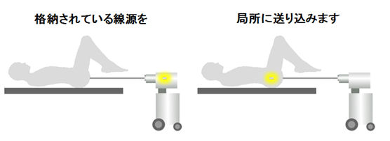 子宮頸癌の小線源療法（腔内照射）